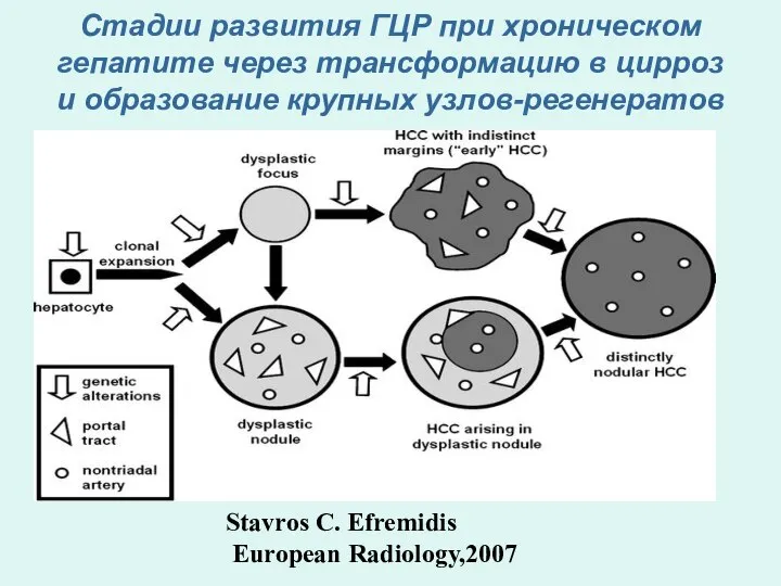 Стадии развития ГЦР при хроническом гепатите через трансформацию в цирроз и