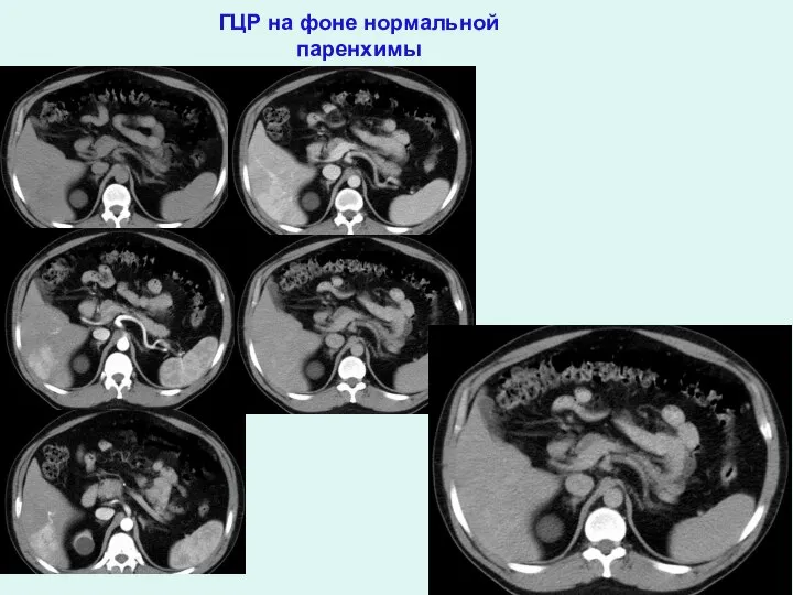 ГЦР на фоне нормальной паренхимы