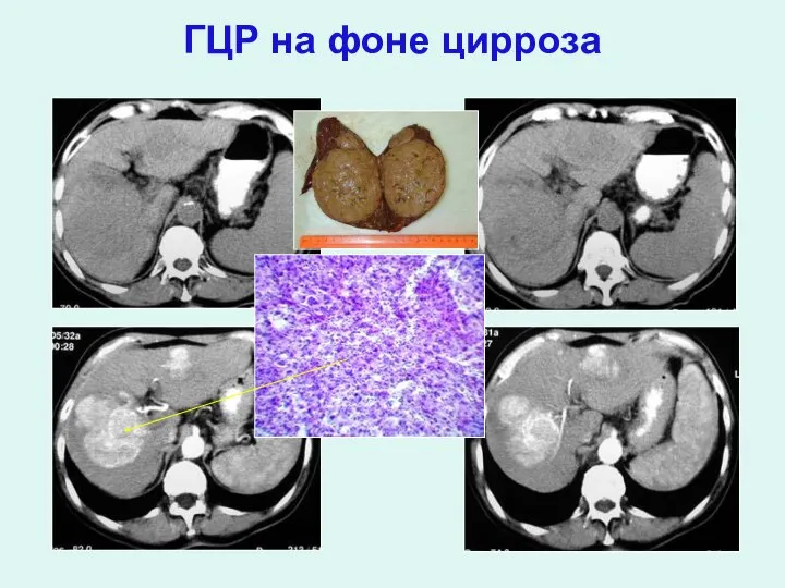 ГЦР на фоне цирроза