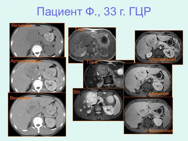 Пациент Ф., 33 г. ГЦР T1в.и. T2в.и. Stir артериальная венозная отсроченная Нативная Артериальная Венозная