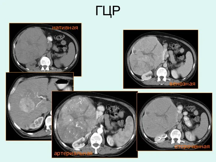 нативная артериальная венозная отсроченная ГЦР