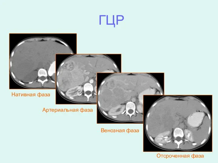 ГЦР Нативная фаза Артериальная фаза Венозная фаза Отсроченная фаза
