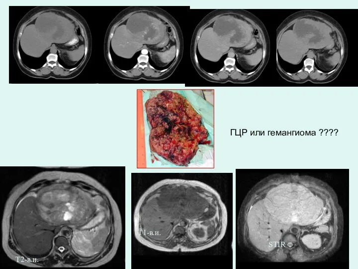 ГЦР Т2-в.и. Т1-в.и. STIR ГЦР или гемангиома ????