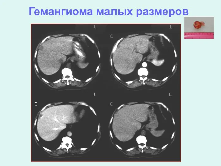 Гемангиома малых размеров