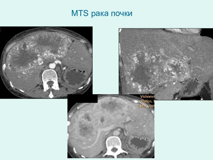 MTS рака почки