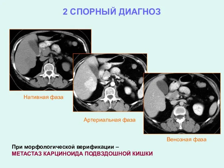 2 СПОРНЫЙ ДИАГНОЗ Нативная фаза Артериальная фаза Венозная фаза При морфологической