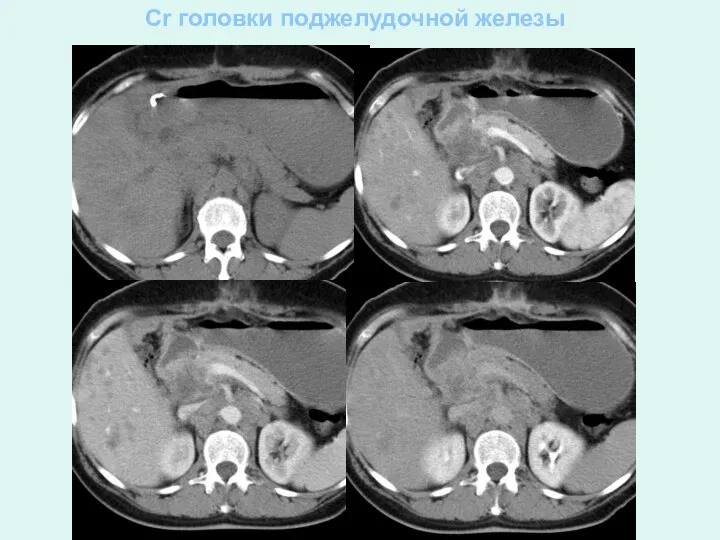 Cr головки поджелудочной железы