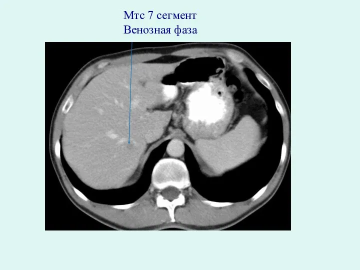 Мтс 7 сегмент Венозная фаза