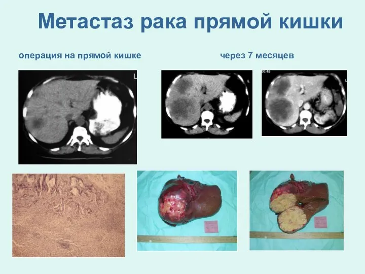 Метастаз рака прямой кишки операция на прямой кишке через 7 месяцев