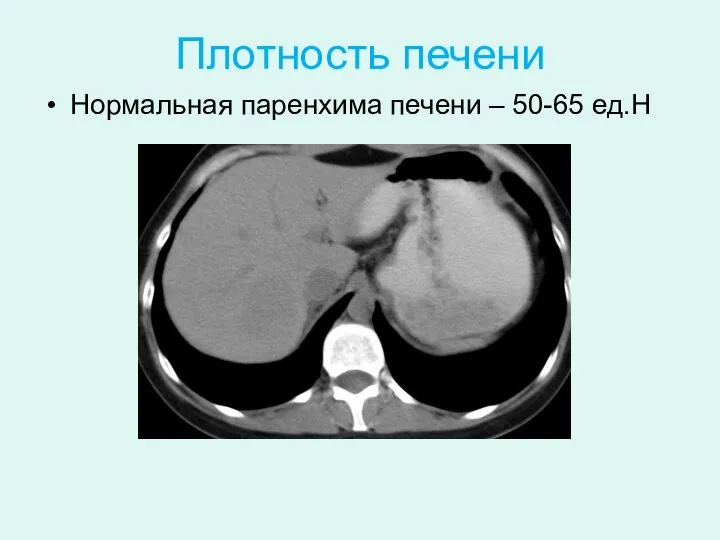 Плотность печени Нормальная паренхима печени – 50-65 ед.Н