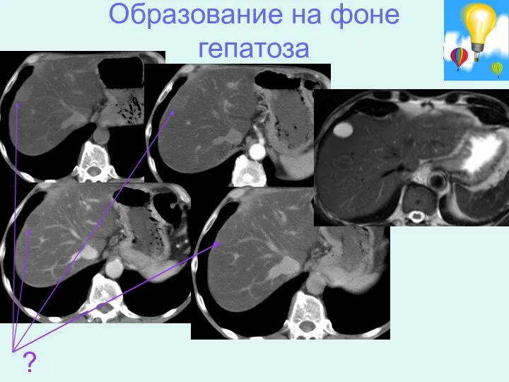 Образование на фоне гепатоза ?