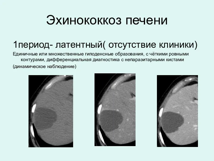 Эхинококкоз печени 1период- латентный( отсутствие клиники) Единичные или множественные гиподенсные образования,