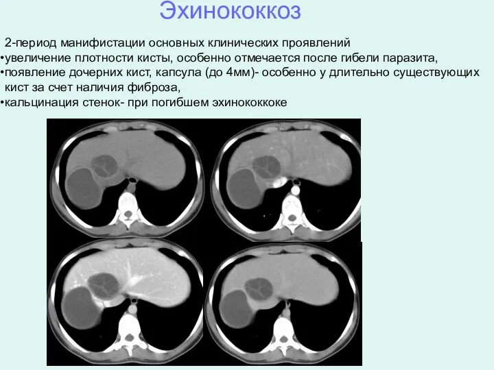 Эхинококкоз 2-период манифистации основных клинических проявлений увеличение плотности кисты, особенно отмечается