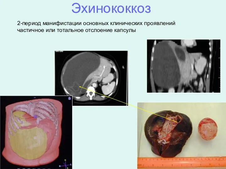 Эхинококкоз 2-период манифистации основных клинических проявлений частичное или тотальное отслоение капсулы