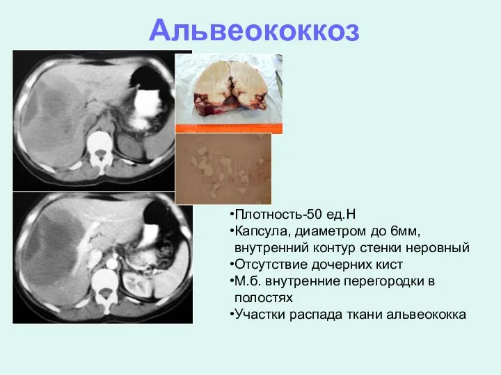 Альвеококкоз Плотность-50 ед.Н Капсула, диаметром до 6мм, внутренний контур стенки неровный