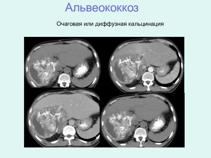 Альвеококкоз Очаговая или диффузная кальцинация