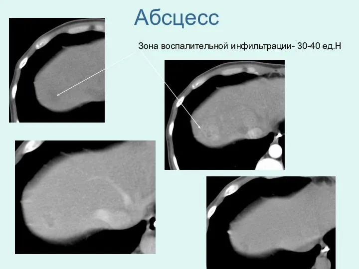 Абсцесс Зона воспалительной инфильтрации- 30-40 ед.Н