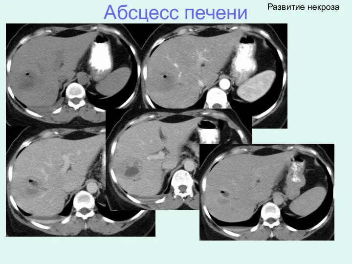 Абсцесс печени Развитие некроза