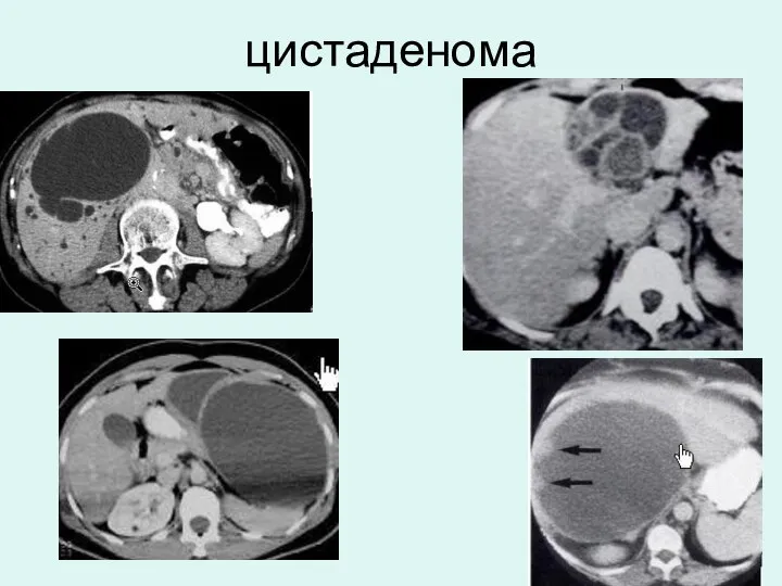 цистаденома