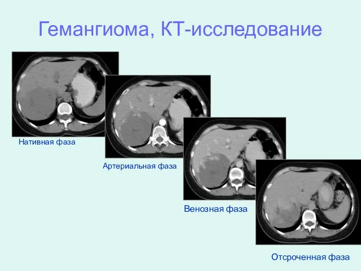 Гемангиома, КТ-исследование Нативная фаза Артериальная фаза Венозная фаза Отсроченная фаза