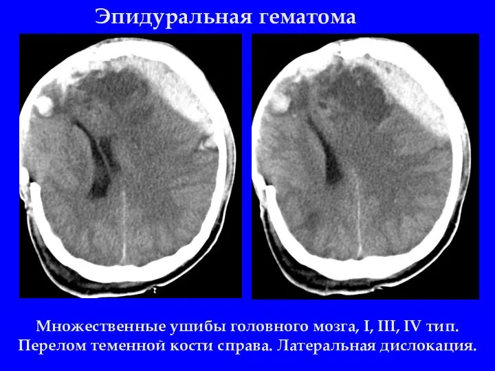 Эпидуральная гематома Множественные ушибы головного мозга, I, III, IV тип. Перелом теменной кости справа. Латеральная дислокация.