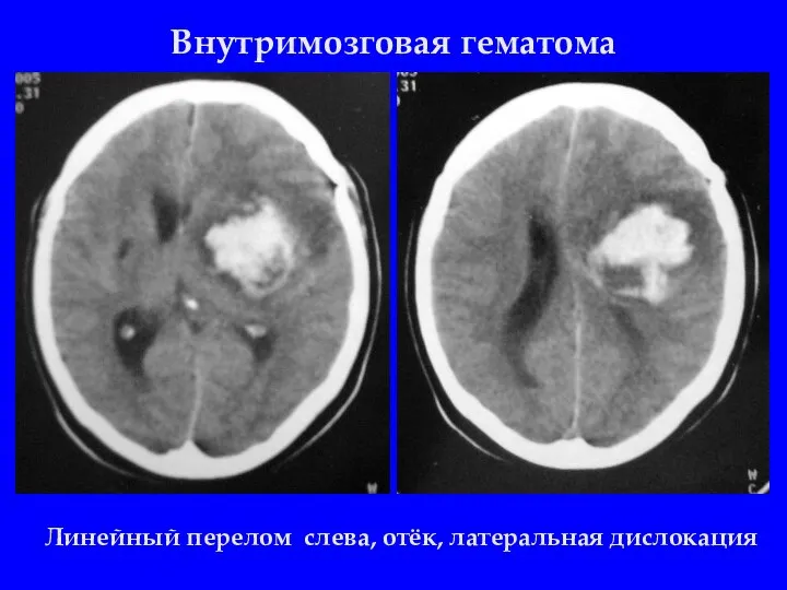 Внутримозговая гематома Линейный перелом слева, отёк, латеральная дислокация