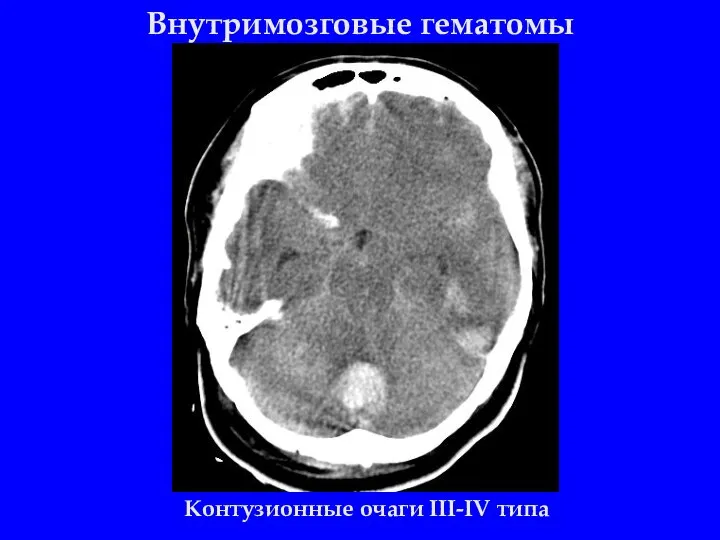 Внутримозговые гематомы Контузионные очаги III-IV типа