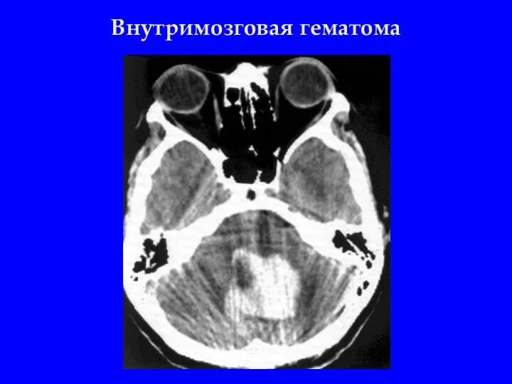 Внутримозговая гематома