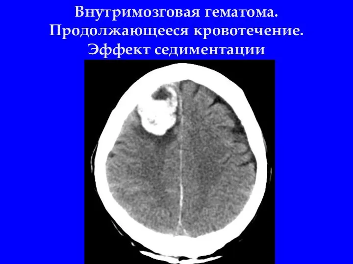 Внутримозговая гематома. Продолжающееся кровотечение. Эффект седиментации