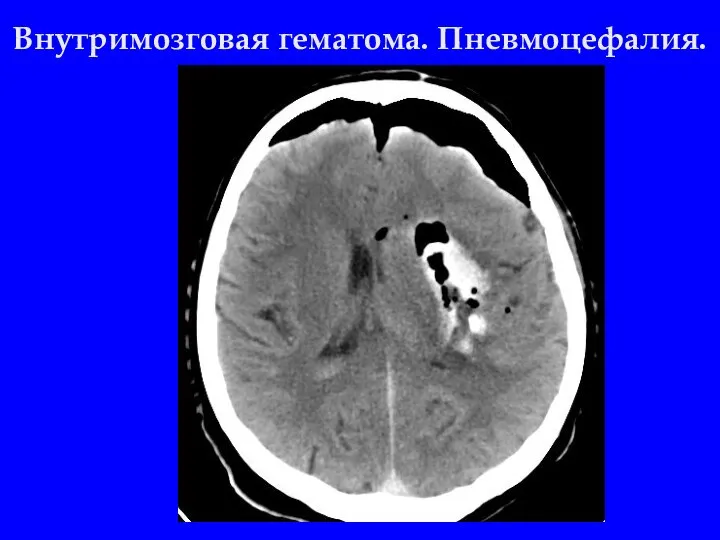 Внутримозговая гематома. Пневмоцефалия.