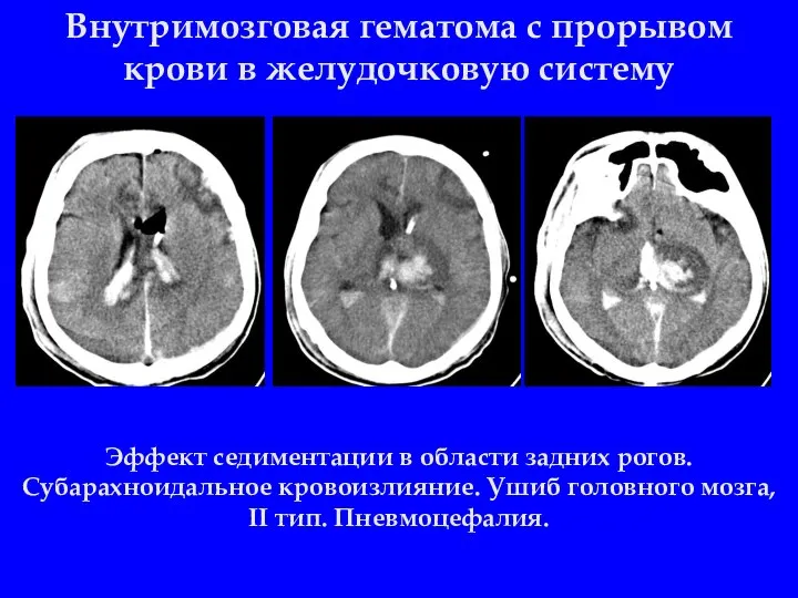 Внутримозговая гематома с прорывом крови в желудочковую систему Эффект седиментации в