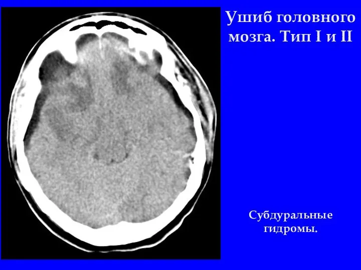 Ушиб головного мозга. Тип I и II Субдуральные гидромы.