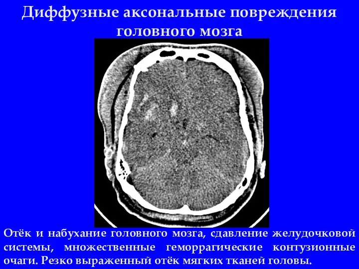 Диффузные аксональные повреждения головного мозга Отёк и набухание головного мозга, сдавление