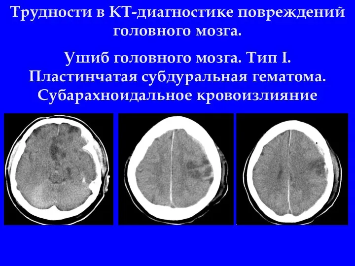 Трудности в КТ-диагностике повреждений головного мозга. Ушиб головного мозга. Тип I. Пластинчатая субдуральная гематома. Субарахноидальное кровоизлияние