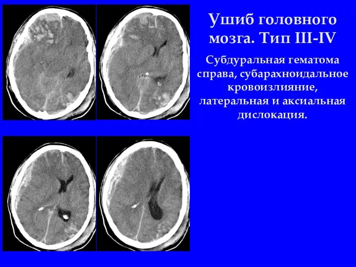 Ушиб головного мозга. Тип III-IV Субдуральная гематома справа, субарахноидальное кровоизлияние, латеральная и аксиальная дислокация.