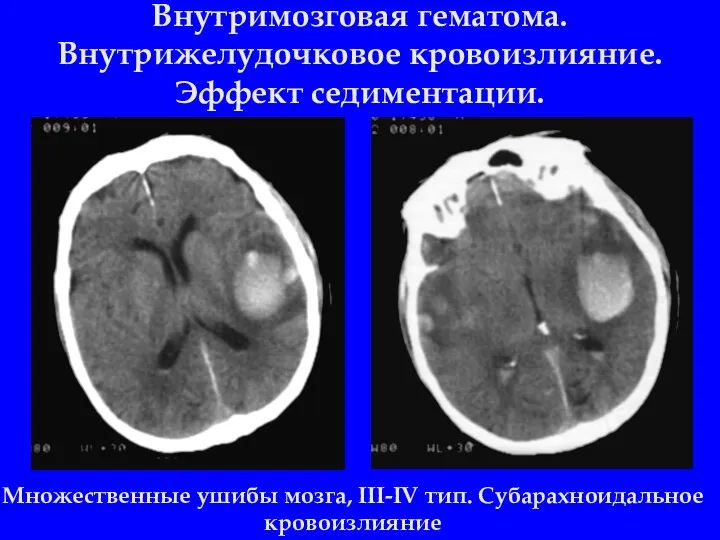 Внутримозговая гематома. Внутрижелудочковое кровоизлияние. Эффект седиментации. Множественные ушибы мозга, III-IV тип. Субарахноидальное кровоизлияние