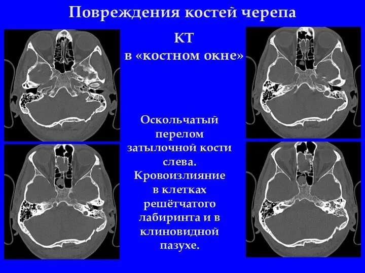 Повреждения костей черепа Оскольчатый перелом затылочной кости слева. Кровоизлияние в клетках