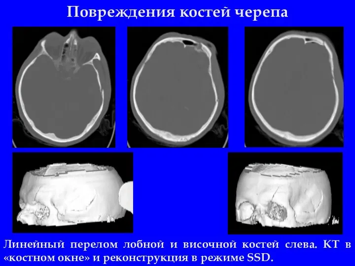 Повреждения костей черепа Линейный перелом лобной и височной костей слева. КТ