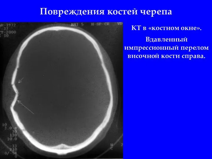 Повреждения костей черепа КТ в «костном окне». Вдавленный импрессионный перелом височной кости справа.