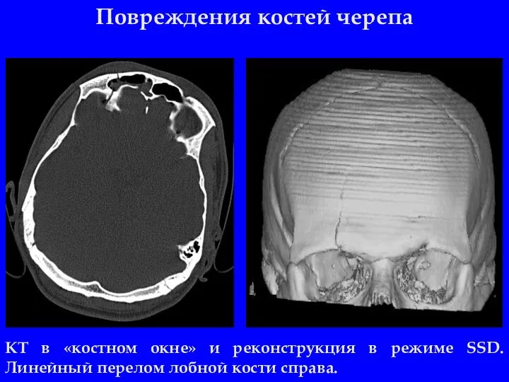 Повреждения костей черепа КТ в «костном окне» и реконструкция в режиме