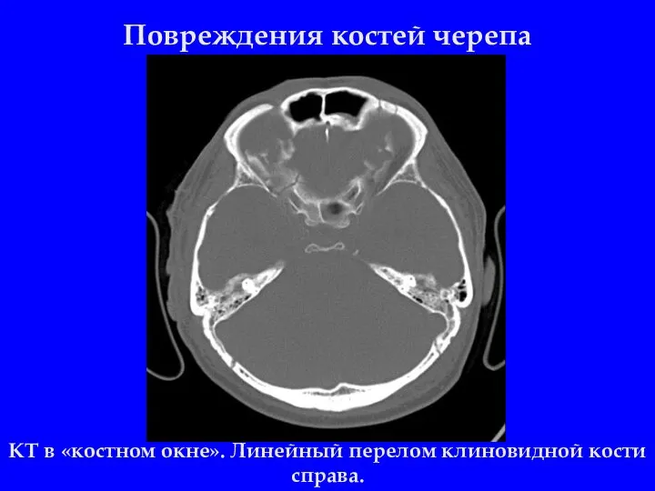 Повреждения костей черепа КТ в «костном окне». Линейный перелом клиновидной кости справа.