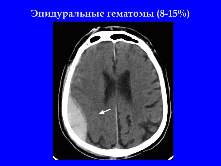 Эпидуральные гематомы (8-15%)