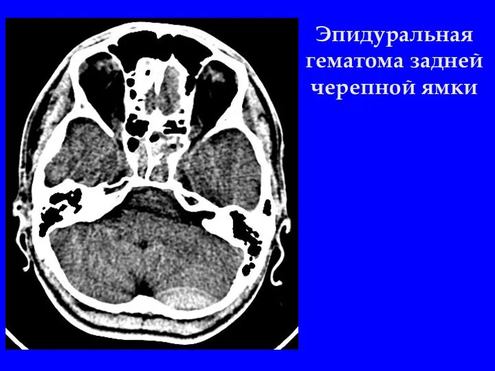 Эпидуральная гематома задней черепной ямки