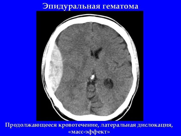 Эпидуральная гематома Продолжающееся кровотечение, латеральная дислокация, «масс-эффект»