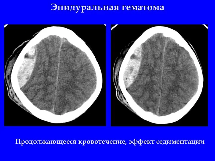 Эпидуральная гематома Продолжающееся кровотечение, эффект седиментации