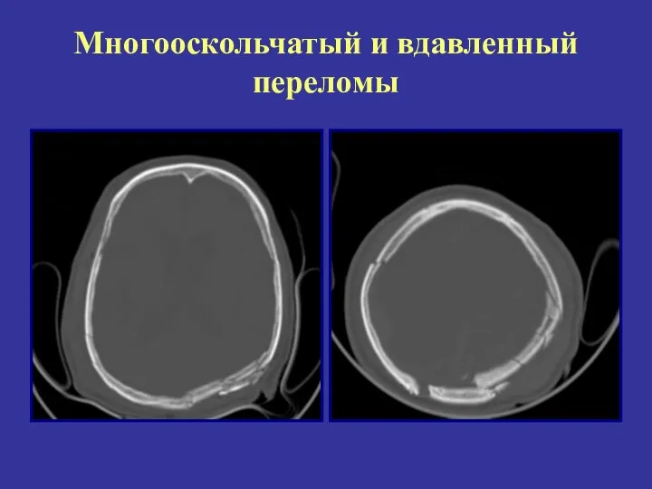 Многооскольчатый и вдавленный переломы