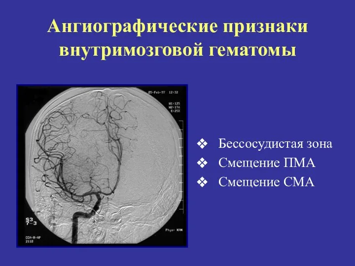 Ангиографические признаки внутримозговой гематомы Бессосудистая зона Смещение ПМА Смещение СМА