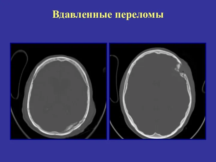 Вдавленные переломы