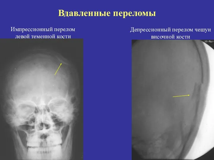 Вдавленные переломы Импрессионный перелом левой теменной кости Депрессионный перелом чешуи височной кости