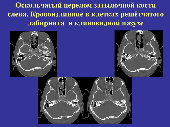 Оскольчатый перелом затылочной кости слева. Кровоизлияние в клетках решётчатого лабиринта и клиновидной пазухе